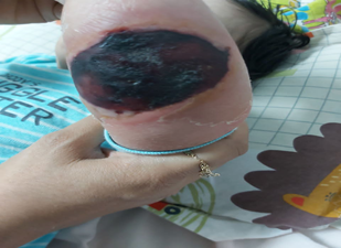 Figure 2: The necrotic lesion shrinkage and liquenification after 7th days of its appearance, at the discharge time.