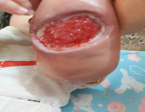 Figure 3: The lesion following spontaneous separation of necrotic part after 3 weeks of its emergence.