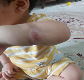 Figure 4: The scar tissue formation at the necrotic lesion after 55 days of its appearance.