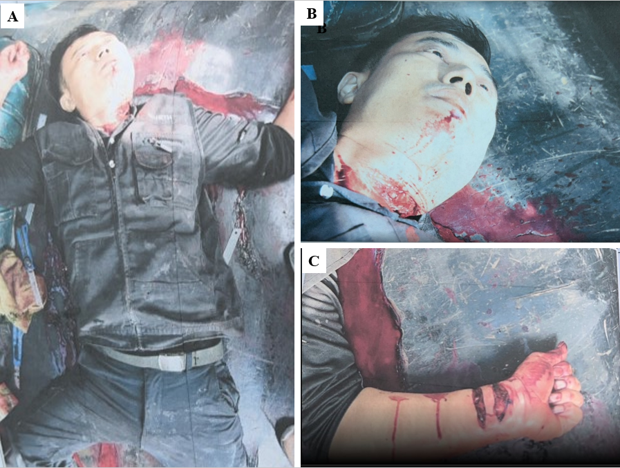 Figure 1: Scene of Multiple Cut Wounds in a 42-Year-Old Male with Massive Blood Pooling and Clotting. A: Two Utility Knives and a Knife Bladder Appeared on his Right-Hand Side; B: Multiple Cut Wounds on his Neck; C: Two Bloody Superficial Hesitate Incision Wounds, 6.4 Cm and 7.5 Cm, Respectively, on his Ventral Side of Left Forearm.