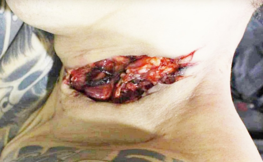 Figure 3: Overview of 4 Clean Hesitate Cut Wounds on the Neck with Clear Sharp Cut Edge from Left to Right, Oblique Downwards Cut Wound Tails and Deep Soft Tissue and Great Vessel Injury.