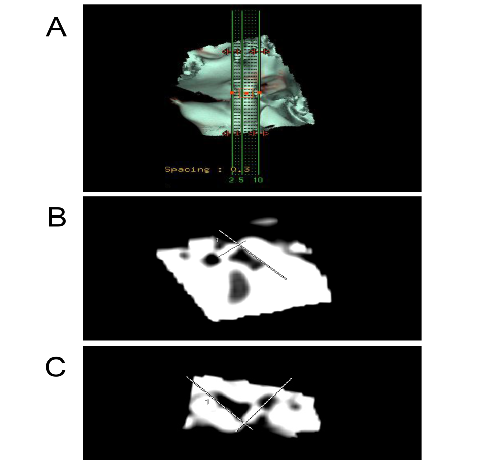 Figure 1: The ears were positioned in an exact upright angle, held on plasticine “blocks” and taken through the scanner. Looking at the resultant images through the computer, we chose the best three views, where all ossicles appeared on the screen in the same projection with respect to the surrounding tympanic and periotic bones. These images were then printed onto blank paper and the angle between the malleus-incus as a unit and the stapes (the incudo- stapedial angle) was measured as described by Skinner, et al. [13] for human ossicles (Figure 1).