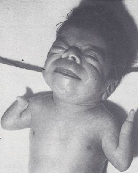 Figure 1: Photograph of a baby with de Lange syndrome. Reproduced from Rao PS, Sissman NJ. J Pediatr 1971; 79:674-7.