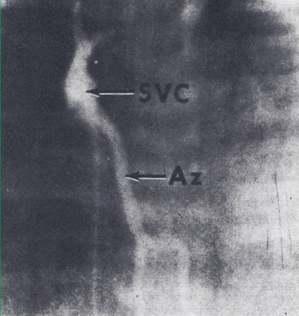 Figure 11: Electrocardiogram showing right atrial and right ventricular hypertrophy. Reproduced from Rao PS, Silbert DR. Brit Heart J 1974; 36:228-32.