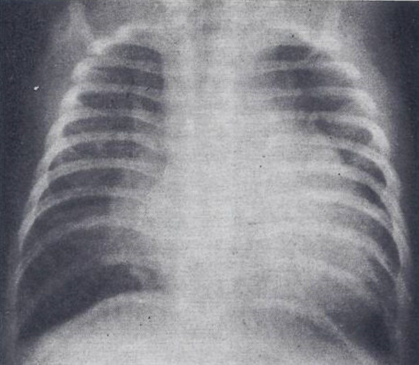 Figure 12: Selected frame from superior vena caval (SVC) cine-angiogram in posteroanterior view showing prompt opacification of the azygos vein (Az). Note absence of opacification of the right atrium. In the cine-angiographic frames that followed the inferior vena cava was filled with contrast subsequent to Az opacification and then the right atrium. Reproduced from Rao PS, Silbert DR. Brit Heart J 1974; 36:228-32.