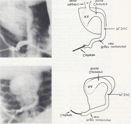 Figure 4: Selected frames from right innominate vein cine-angiograms in postero-anterior (top) and left anterior oblique (bottom) projections, demonstrating the connection of the right innominate vein to a persistent left superior vena cava (PLSVC) which empties into the coronary sinus and right atrium (RA). The hepatic veins seem to enter the RA directly. Also note the absence of the right superior vena cava. The line drawings on the right are provided to improve the clarity. Reproduced from Rao PS, Molthan ME, Am J Dis Child 1973; 125:749-52.