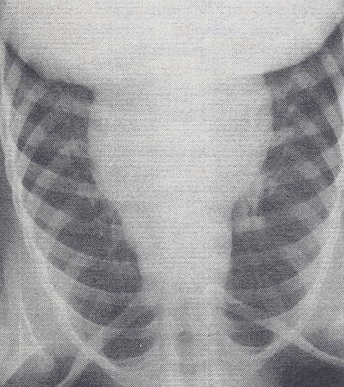 Figure 6: Chest x-ray film in antero-posterior view showing mesocardia. Reproduced from Rao PS, Molthan ME, Am J Dis Child 1973; 125:749-52.