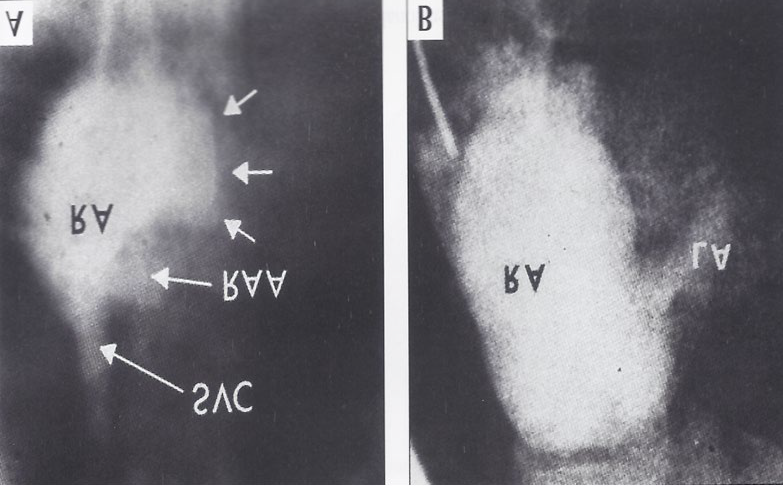 Figure 8: The baby improved following CHF therapy with digoxin and diuretics.