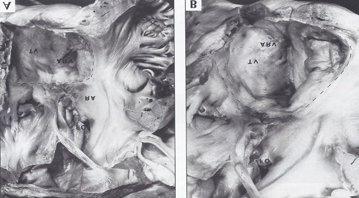 Figure 9: The interior of the right atrium and the atrialized right ventricle (ARV) are shown. B. This is close-up of A. The interrupted line demarcates the true tricuspid valve annulus. The tricuspid valve (TV) leaflets are displaced downward (Ebstein’s malformation) and fused, incorporating a part of the right ventricle into the right atrium (RA). FO, fossa ovalis. Reproduced from Rao PS, et al. [7].