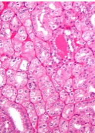 Figure 1: Chromophobe renal cell carcinoma demonstrating papillae and alveoli lined by enlarged cells imbued with eosinophilic cytoplasm and irregular wrinkled nuclei with perinuclear halos. Surrounding stroma is minimal [5].
