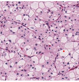 Figure 2: Chromophobe renal cell carcinoma delineating cords and papillae lined by tumour cells permeated with eosinophilic cytoplasm and wrinkled, irregular nuclei with perinuclear halos. Intervening stroma is minimal (Table 1) [6].
