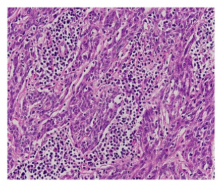 Figure 2: Lymphoepithelial carcinoma demonstrating clusters of enlarged, polygonal cells incorporated with abundant cytoplasm, vesicular nuclei and prominent nucleoli. A dense exudate of small lymphocytes and plasma cells encompass neoplastic cells [6].