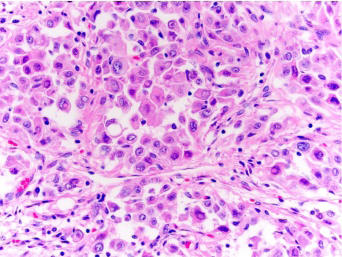 Figure 1: ALK rearranged renal cell carcinoma demonstrating sheets of cells imbued with eosinophilic cytoplasm, intracytoplasmic vacuoles, polymorphic nuclei and miniature nucleoli. Tumour cells infiltrate renal parenchyma [5].