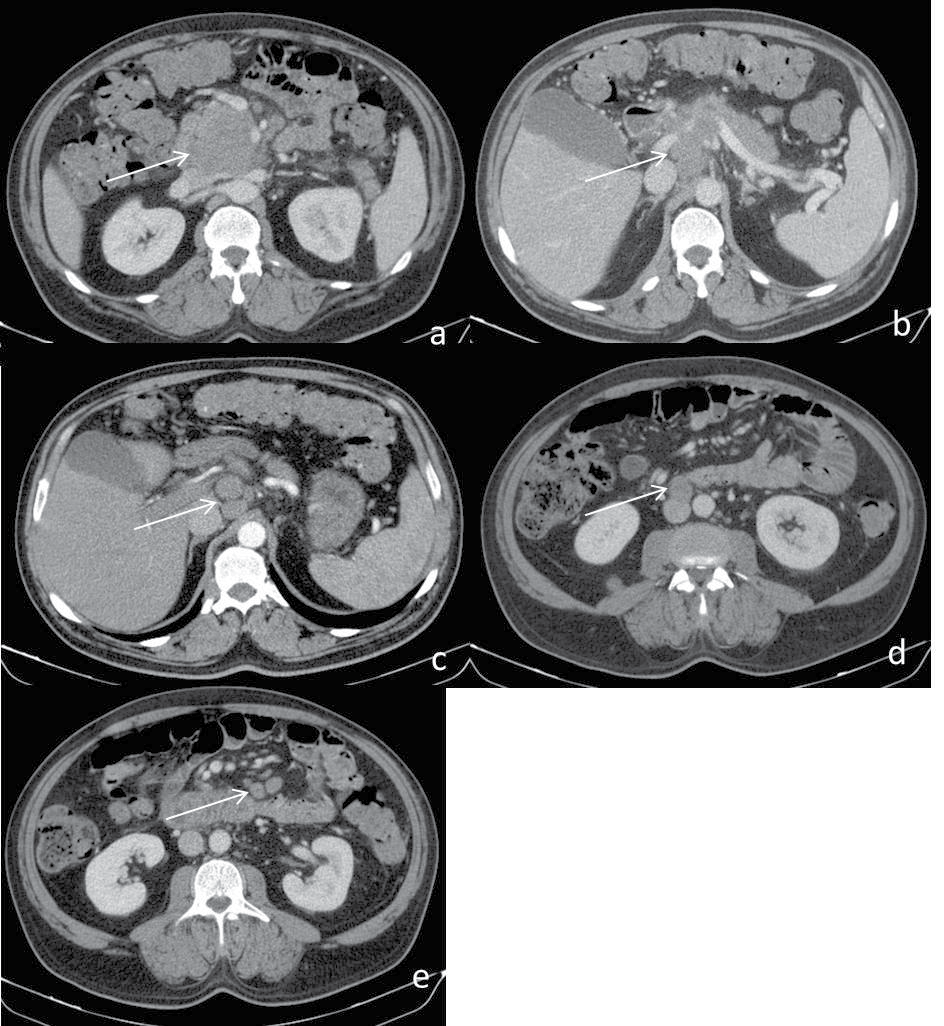 Figure 1: Abdominal CT scan, arterial and portal venous phases – solid mass adjacent the pancreatic head (a); retroperitoneal lymphadenopathies: interaortocaval (b, c), precaval (d), mesenteric (e).
