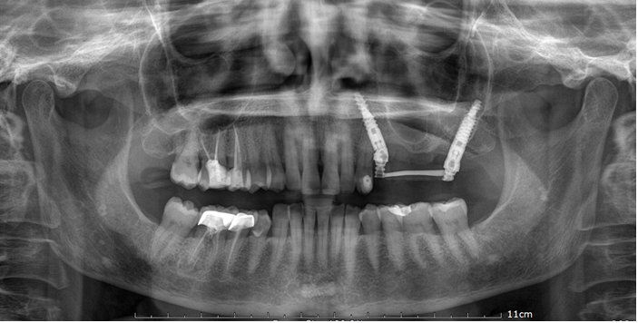 Figure 2: Orthopantomagram x-ray 24 hours after treatment. Two dental extractions (2.5 and 2.7) in the upper arch. Two dental immediate post-extractive implants. One trans-sinus tilted implant (4,2x18 mm; Noris Medical) and one pterygoid implants (4,2x20 mm; Noris Medical). Immediate loading of a 4 unit temporary screwed partial fixed bridge with a resin based titanium structure.