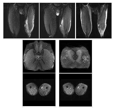 Figure 2: Magnetic resonance imaging indicates contrast enhanced liquid formations of the left groin area descending to the medial and ventromedial thigh. An Abscess formation of the proximal ventral thigh can be seen (↑). Enlarges lymphatic nodules of both sides are present. Extended bilateral foreign body inclusions in the subcutaneous tissue in the pelvic area and gluteal region are detectable (*).