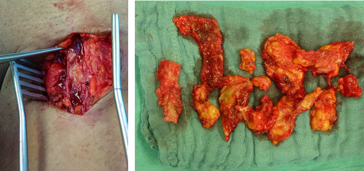 Figure 3: A longitudinal incision on the ventral thigh revealed an oily granulomatous substance (*) that had formed a duct- like epithelized capsula. Radical debridment of the inflammated and abceeding subcutaneous tissues with adherent PAIG- Formations.