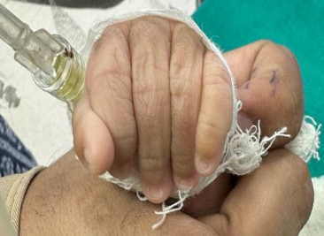 Figure 1: Normal Nails of Left hand.
