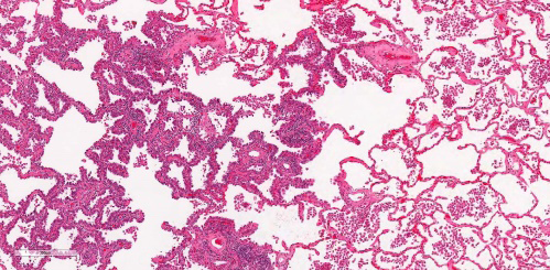 Figure 2: Minimally invasive adenocarcinoma demonstrating preponderant lepidic pattern with tumour cells layering alveolar spaces. Foci of invasion within encompassing stroma are evident [8].