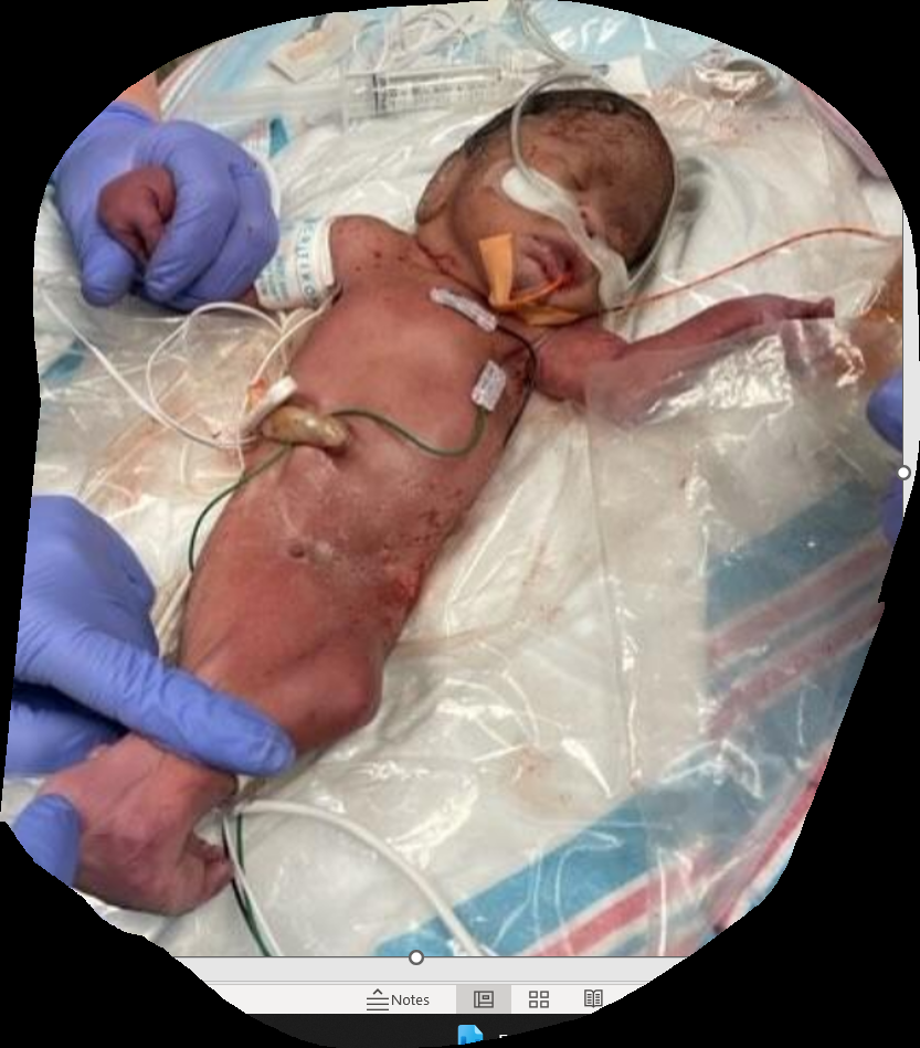 Figure 1: Postnatal physical exam of neonate with Sirenomelia showing microcephaly, ambigious genitalia, webbed legs with knee joints fused bilaterally, fused feet, and two vessel cord.
