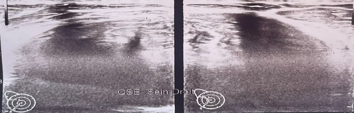 Figure 2: Mammary ultrasound showing the first oval formation in right breast’s upper outer quadrant which long axis is parallel to the skin and echostructure is hypoechogenic and heterogeneous, measuring 69x40 mm.