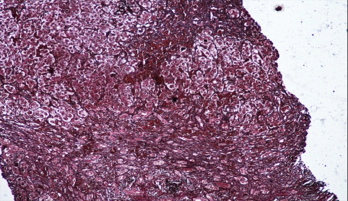 Figure 4: Reticulin stain showing fibrosis and nodule formation.