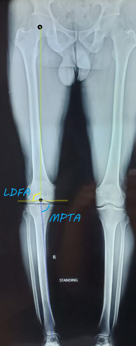 Figure 1: LDFA and MPTA.