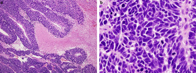 Figure 2: Squamous cell carcinoma delineating clusters of polygonal squamous epithelial cells pervaded with abundant, eosinophilic cytoplasm, enlarged vesicular nuclei and elevated nucleocytoplasmic ratio. Cellular and nuclear atypia is significant (Table 1).