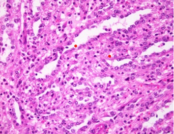 Figure 1: Collecting duct carcinoma enunciating nests, cords, papillae and tubules lined by pleomorphic epithelial cells pervaded with enlarged, high grade nuclei, coarse nuclear chromatin and prominent nucleoli. Surrounding stroma is desmoplastic and inflamed [5].