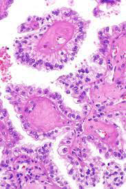 Figure 2: Fumarate hydratase deficient renal cell carcinoma exhibiting papillae with fibro-vascular cores layered by epithelial cells pervaded with abundant cytoplasm and vesicular nuclei with nucleolar inclusions and peri-nucleolar clearing.