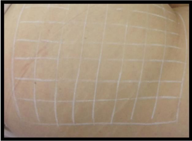 Figure 1: Demarcation of skin area to be treated with 1.5cm2. Evaluation