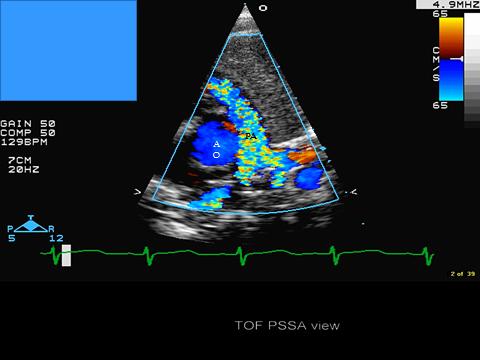 Figure 5: showing turbulent color flow within the small main pulmonary artery.