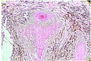 Figure 2: Squamomelanocytic Tumor Showing Squamous Cell Carcinoma Intermixed with Malignant Melanoma (100x H&E).