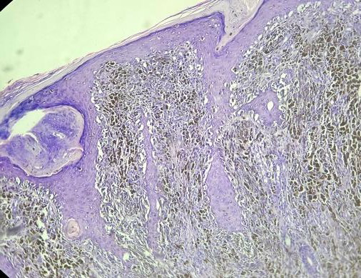 Figure 3: Transepidermal Migration of Malignant Melanoma in Pagetoid Pattern (100x H&E).