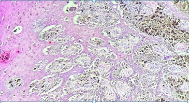 Figure 4: Malignant Melanoma, Tumor Cells Arranged In Nests and Sheets (100x H&E).