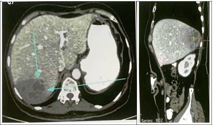 Figure 1: CT scan of abdomen and pelvic (baseline).