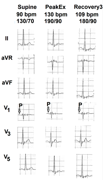 Figure 1: Selected electrocardiographic leads from the treadmill test of the first case. Supine electrocardiogram is normal. There is no electrocardiographic evidence of myocardial ischemia. There is no change in the P wave of lead V1 during exercise and recovery (marked as ⇩).