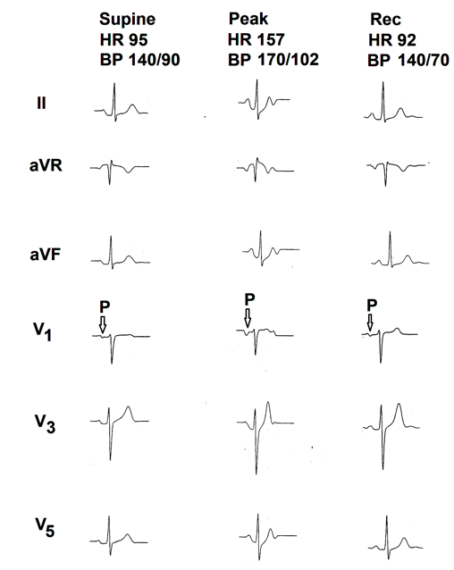 Figure 2: Selected electrocardiographic leads from the treadmill test of the second case. Supine electrocardiogram is normal. There is no electrocardiographic evidence of myocardial ischemia during exercise and recovery. There is increase in the terminal negative deflection of the P wave in lead V1 (marked as ⇩) at peak exercise. P wave normalized by the end of fifth minute of recovery.