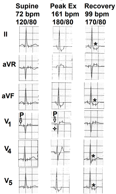 Figure 4: Selected electrocardiographic leads from the treadmill test of the fourth case. Resting supine electrocardiogram is normal. There is no evidence of myocardial ischemia during exercise and recovery. P wave in lead V1 (marked as ⇩) was positive in supine position. It became negative (more than 0.04 mm sec) at peak exercise (marked as ✦). Downsloping ST-segment depression appeared in leads II, aVF, V4 and V5 during 5th minute of recovery. (marked as ∗).