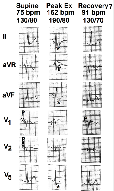 Figure 5: Selected electrocardiographic leads from the treadmill test of the fifth case. Resting supine electrocardiogram is normal. P wave shows shallow inversion in lead V1. P wave in lead V2 is biphasic (+/-) (marked as ⇩) There is ST-segment depression in leads II, III, aVF, V5 and V6 (marked as ∗) and ST-segment elevation in lead aVR (marked as ✦) at peak exercise. At peak exercise, P wave is prominently negative in leads V1 and V2 (marked as ⦁). P wave depth decreased progressively during recovery. At the end of seventh minute of recovery the P wave in lead V1 shows shallow inversion and the P wave in lead V2 has become position (marked as ⇧).