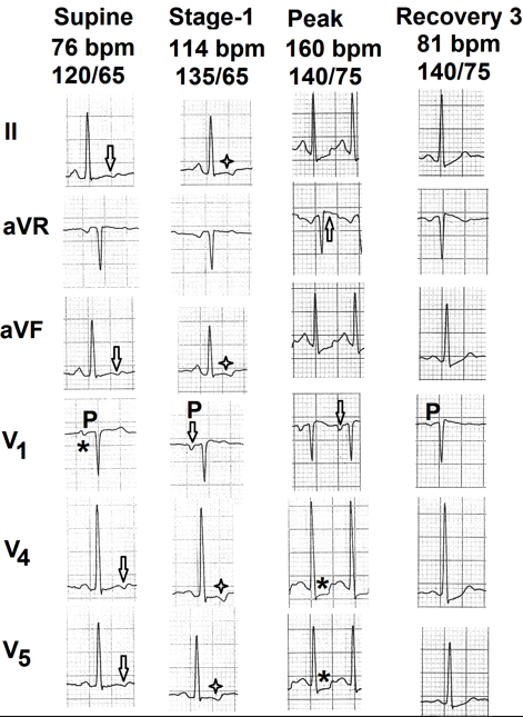 Figure 6: Selected electrocardiographic leads from the treadmill test of the sixth case. Resting supine electrocardiogram shows biphasic (+/-) P wave in lead V1 (marked as ∗). There is inversion of initial part of T wave in leads II, aVF, V4 and V5 (marked as ⇩). During stage 1 P wave in lead V1 is negative (marked as ⇩) and there is mild ST-segment depression in leads II, aVF, V4 and V5 (marked as ✦). At peak exercise P wave in lead V1 is negative (marked as ⇩). Leads V4 and V5 show clear ST- segment depression (marked as ∗). By the end of third minute of recovery (rec3) depth of the P wave in lead V1 is significantly reduced and the ST-segment depressions in leads V4 and V5 have normalized.