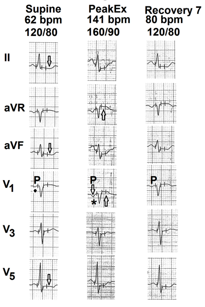 Figure 7: Selected electrocardiographic leads from the treadmill test of the seventh case. Resting supine electrocardiogram shows mild nonspecific ST-segment depression in leads II, aVF and V5 (marked as ⇩) P wave in lead V1 shows shallow inversion (marked as ⦁). At peak exercise P wave in lead V1 is prominently negative (marked as ∗). There is elevation of the ST-segment in leads aVR and V1 (marked as ⇧). By the end of seventh minute of recovery, depth of P wave in lead V1 is significantly reduced and ST- segment elevation in leads aVR and V1 have normalized.
