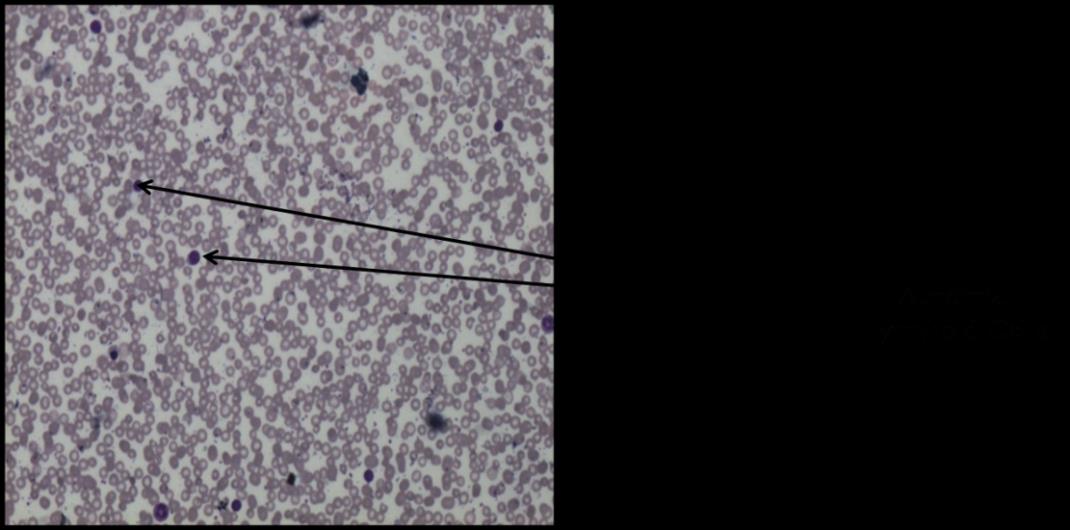 Figure 1: Peripheral blood film showing 50% abnormal lymphoid cells; May Grunwald Giemsa stain 10X.
