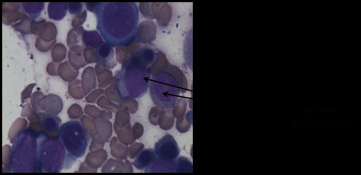 Figure 2: Bone marrow aspirate showing 30% abnormal lymphoid cells; May Grunwald Giemsa stain 50 X (Oil immersion field).