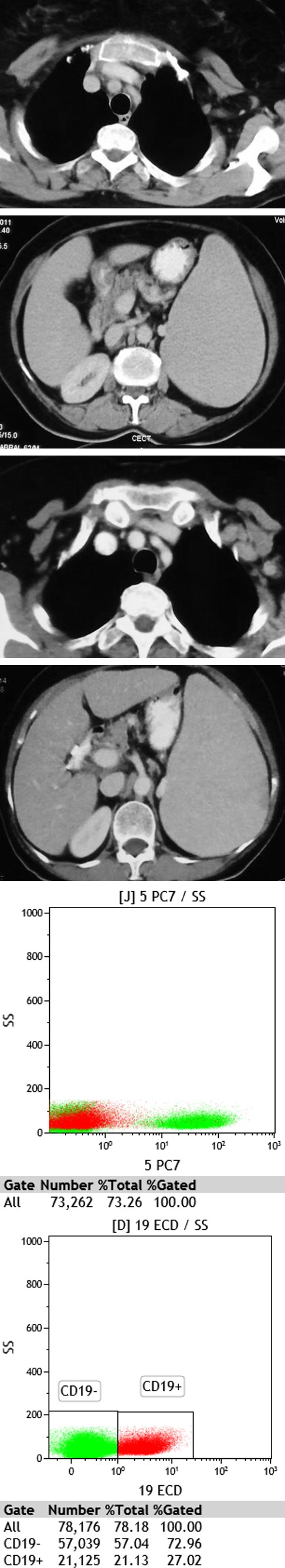 Figure 5: CT A & B: Axial CT image (at first presentation) showing moderate splenomegaly with no axillary lymphadenopathy; C & D 2014 axial CT image showing moderate splenomegaly with new appearance of left axillary lymphadenopathy.