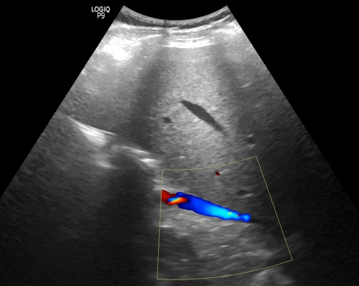 Figure 1: US-VCI - view of VCI in Doppler mode in longitudinal section.
