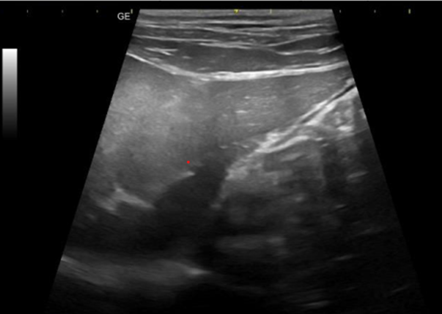 Figure 2: Ultrasound of liver. Liver presenting enlarged dimensions (hepatomegaly). Liver lobes with homogeneous parenchyma and absence of focal changes, rounded contours and diffusely increased echogenicity (fatty infiltration), vascular architecture with preserved path and calibers.