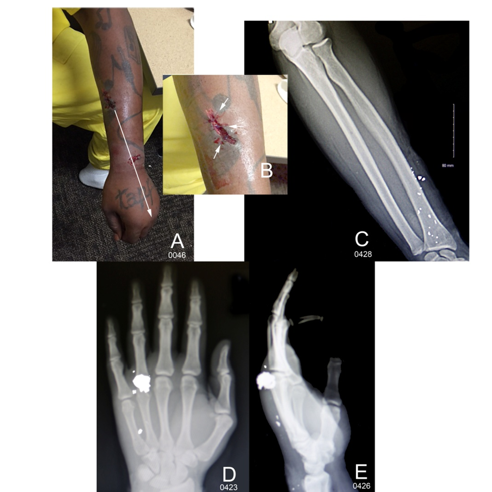 Figure 10: Bullet wound into the left forearm Harris; the bullet was only the lead core which was separated from its jacket upon hitting an intermediate target (either the concrete floor of the room or more likely the ricochet from the bullet which created the wall defect C (Fig. 8B)). A. The defendant’s left arm showing the extremely ragged entrance wound; the arrow shows the core travel within the arm to the dorsal hand. B. A close-up image of the wound; arrows point to sutures. C. X-ray image showing the lead debris track (small white spots) left by the lead core as it traveled distally to the hand. D and E. X-rays of the lead bullet core in the dorsal hand.