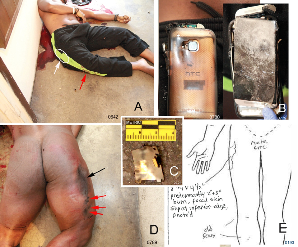 Figure 4: A. The victim at the shooting scene; his cell phone was in a pocket in his sweatpants at white arrow; bloodstains on the yellow stripe (red arrow) of the sweatpants indicate a bleeding event occurred prior to the fatal shooting into the head of the victim. The lack of burning the pant leg over the cell phone indicates the hot surface of the cell phone was against the victim’s skin and was the heat source that caused second and third degree burns to his right thigh. B. The crushed and heat damaged cell phone which was removed from the sweatpants without disturbing the body position; left, the back of the phone; right, the screen side of the phone. C. Evidence item 19 was determined by a crime lab criminalist to be not part of the shooting scene, which is likely incorrect. This is a piece of the victim’s cell phone indicating it fragmented perhaps when dropped on the floor. D. The victim’s body at the scene with sweatpants removed showing the burn area on his right thigh (black arrow) which places the phone in the approximate position at the white arrow in A when the thigh burn occurred; red arrows point to apparent additional burns distal to the main burn. E. Pathologist’s diagram describing the burn on the victim’s right thigh as second and third degree burns.