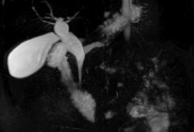 Figure 2: CT scan showing pancreatic duct calculi.